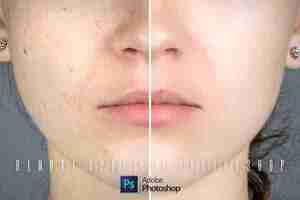 Skin Smoothing: Removing Acne and Blemishes in Adobe Photoshop